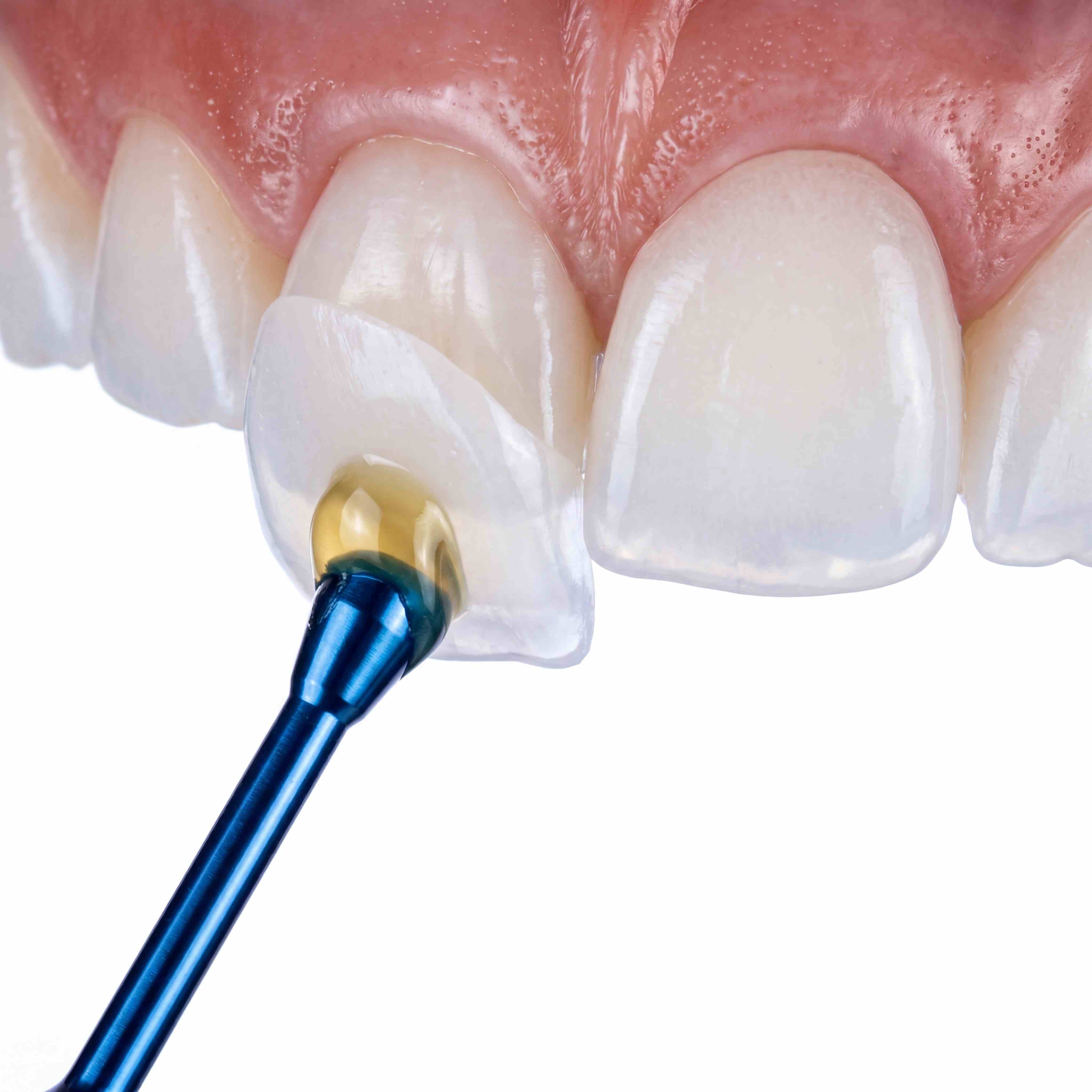Porcelain veneer application - ultra-thin shell being placed on tooth