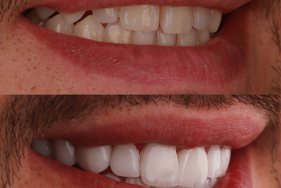 Veneer transformation - before and after